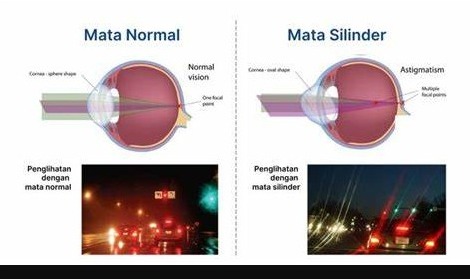 Mata Silinder