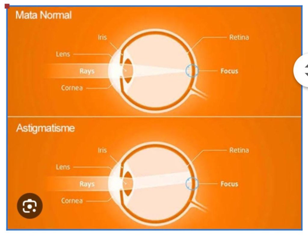 mata silinder dan mata normal