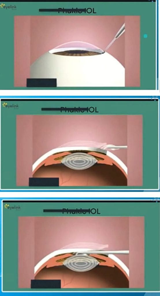 Operasi Mata Silinder