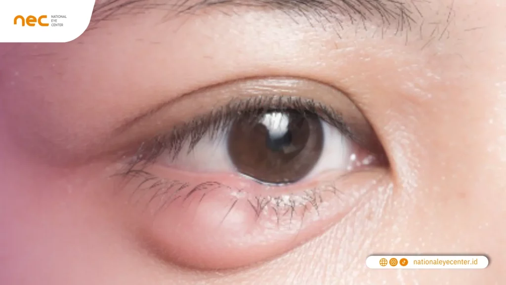 Bagaimana Cara Mengobati Mata Bintitan Bagaimana Cara Mengobati Mata Bintitan