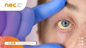 Penyebab Mata Kuning