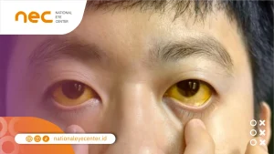 Kondisi Mata Kuning (Ikterus)