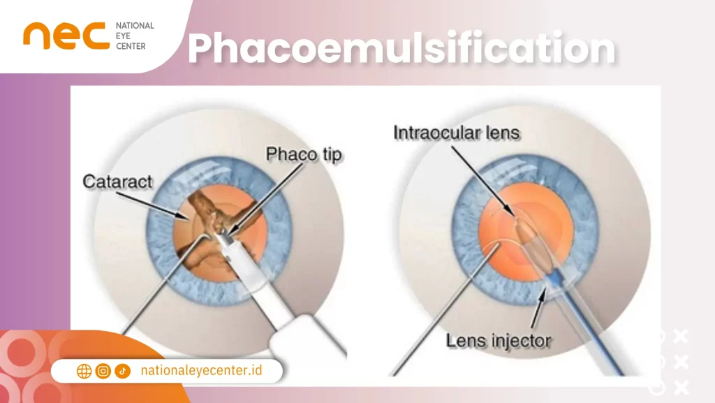 Phacoemulsification Operasi Mata Katarak: Phacoemulsification