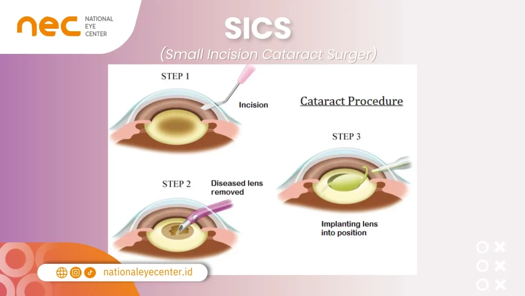 Operasi Mata Katarak: SICS (Small Incision Cataract Surgery) Operasi Mata Katarak: SICS (Small Incision Cataract Surgery)
