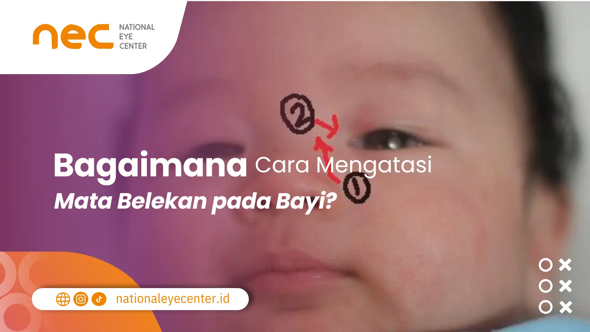 Cara mengatasi bayi belekan