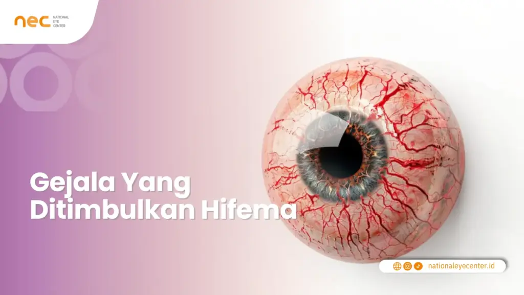 Gejala Yang Ditimbulkan Hifema