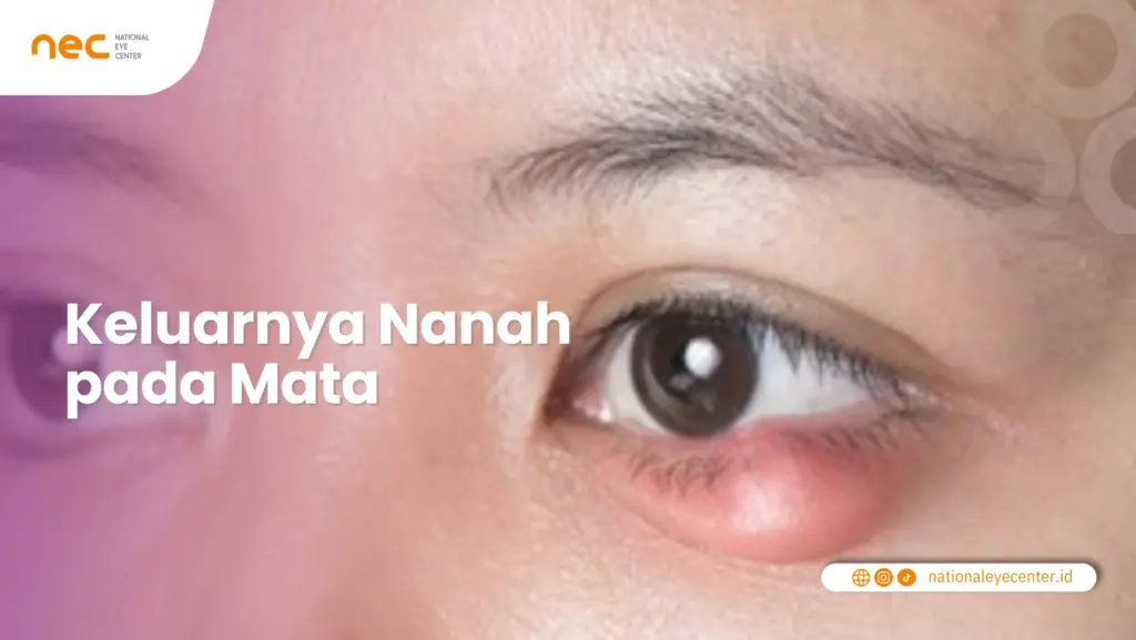 Keluarnya Nanah pada Mata