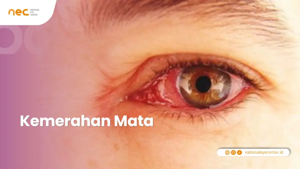 Kemerahan Mata