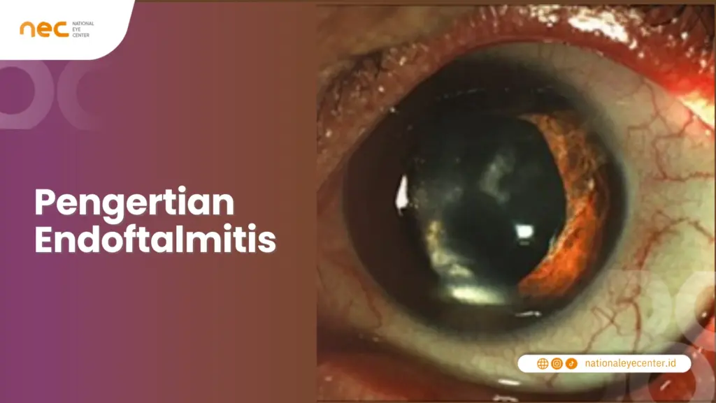 Pengertian Endoftalmitis