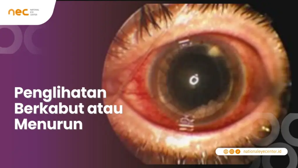 Penglihatan Berkabut atau Menurun
