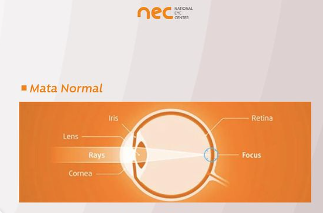 bentuk bola mata normal , bukan bentuk bola mata minus