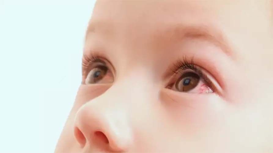 mata merah pada anak tak kunjung sembuh