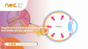 Bagaimana Cara Menurunkan Tekanan Bola Mata? Simak Tipsnya!