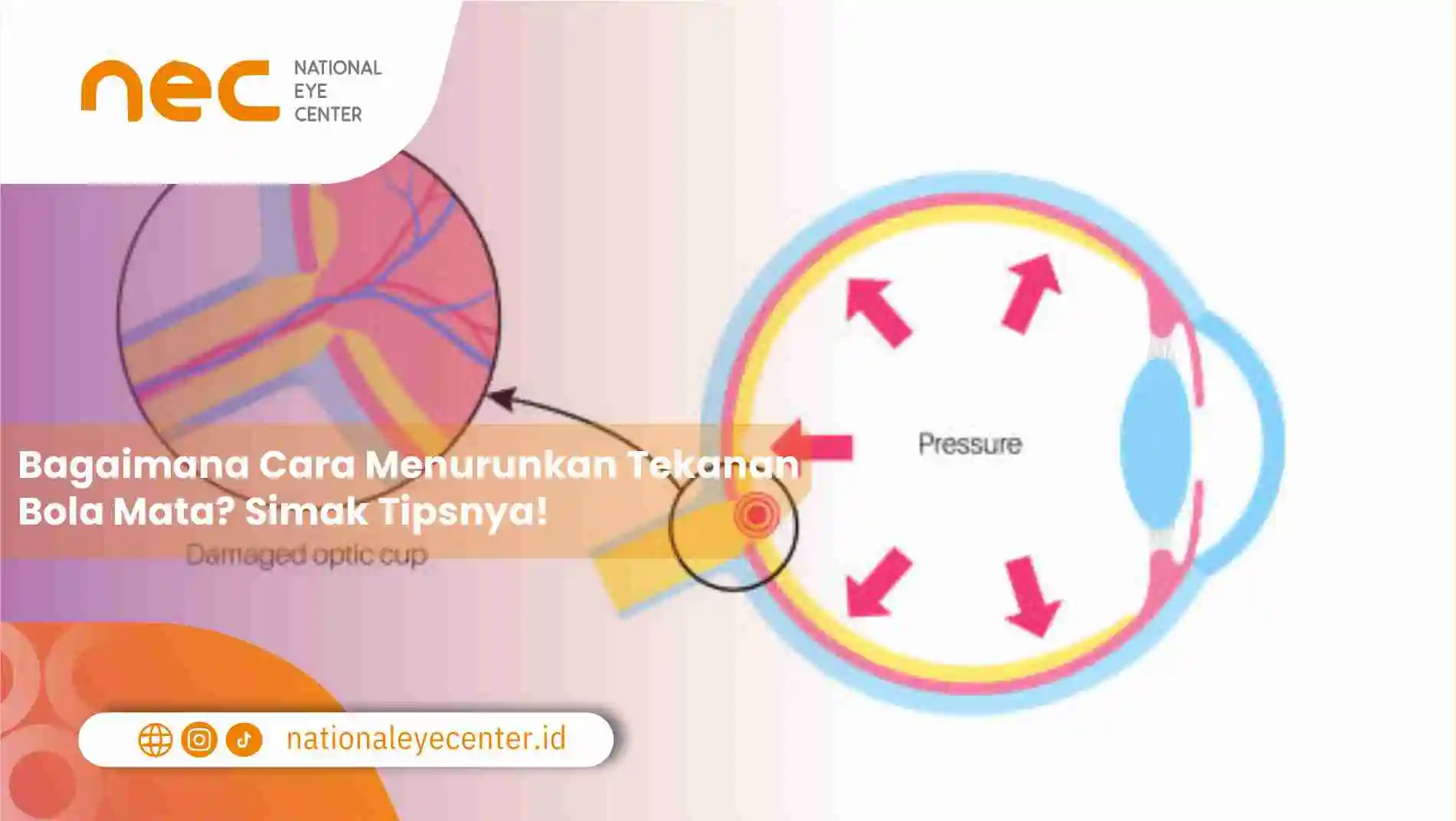 Bagaimana Cara Menurunkan Tekanan Bola Mata? Simak Tipsnya!