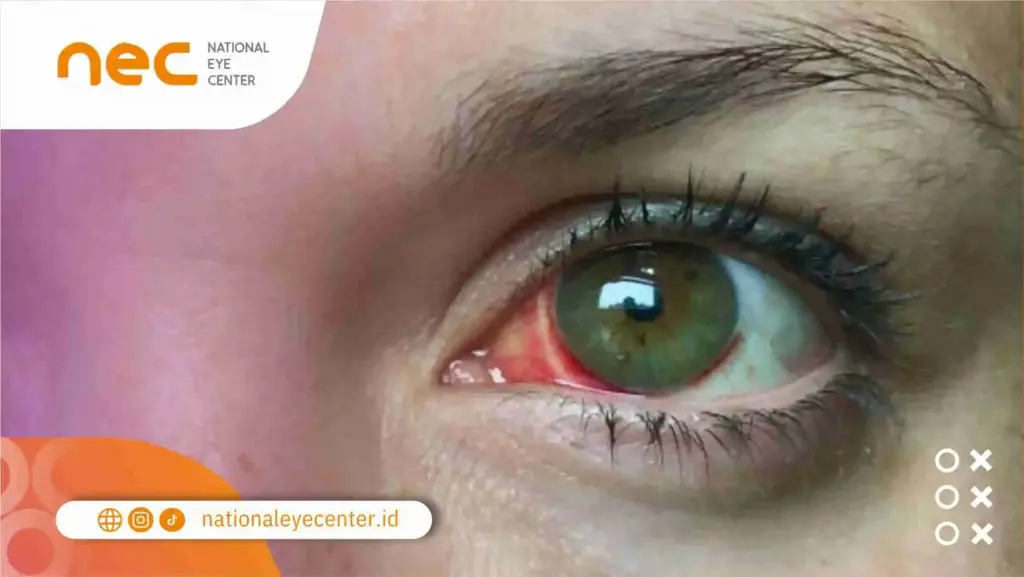 Apa Ciri-ciri Pembuluh Darah Mata Pecah?