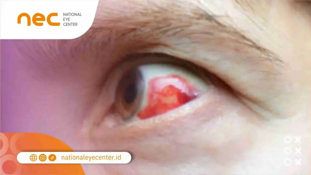 Apa yang Harus Dilakukan jika Pembuluh Darah Pecah?