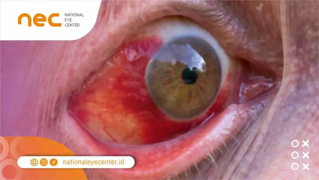 Penyebab Pembuluh Darah Mata Pecah