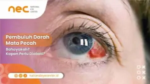 Pembuluh Darah Mata Pecah: Bahayakah? Kapan Perlu Diobati?