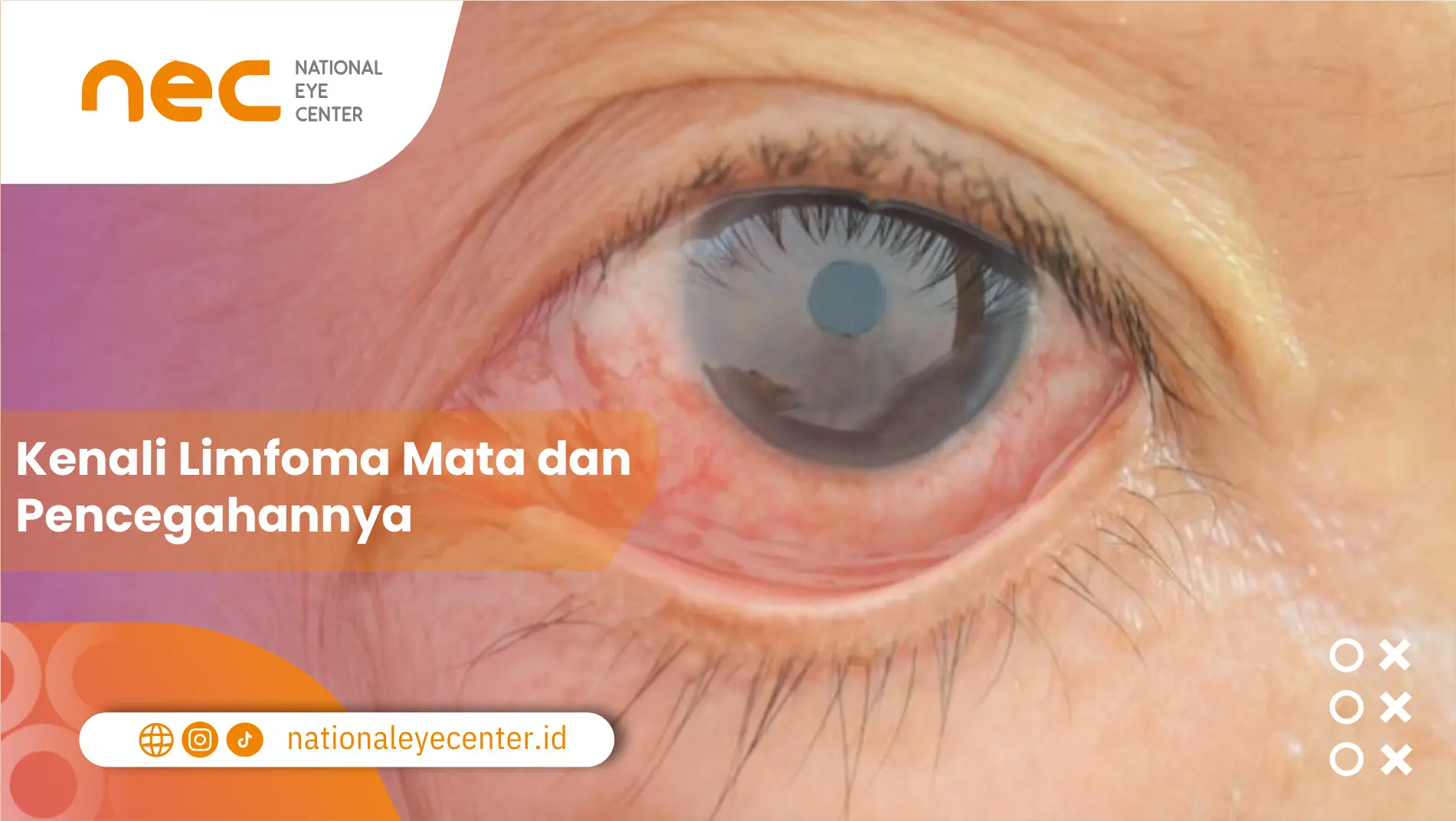 Kenali Limfoma Mata dan Pencegahannya