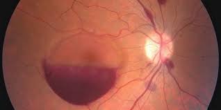 pendarahan retina
