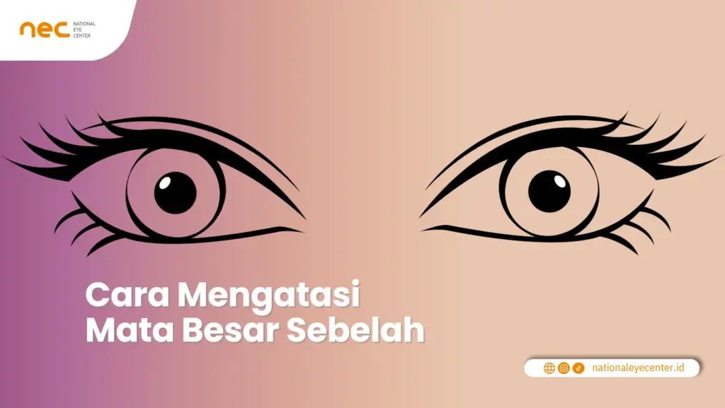 Cara Mengatasi Mata Besar Sebelah Cara Mengatasi Mata Besar Sebelah