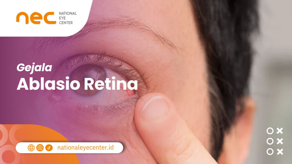 Gejala Ablasio Retina
