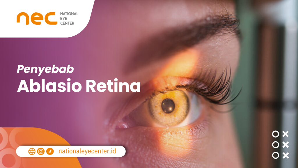 Penyebab Ablasio Retina