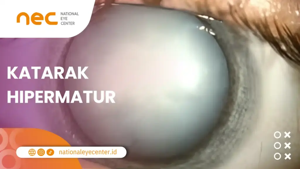 Stadium Katarak Hipermatur