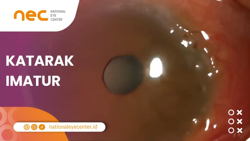 Stadium Katarak Imatur