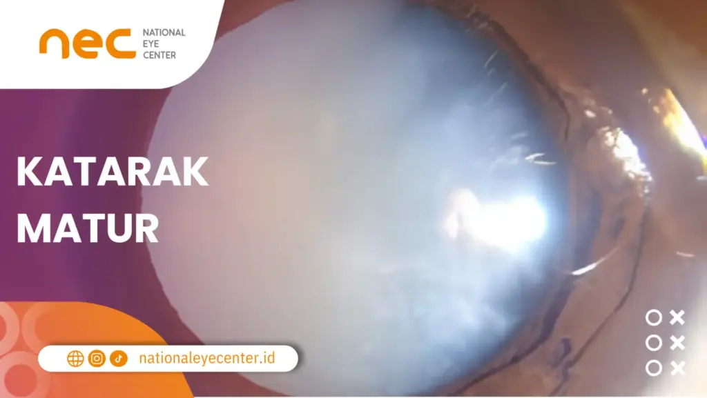 Stadium Katarak Matur