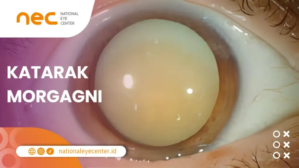 Stadium Katarak Morgagni