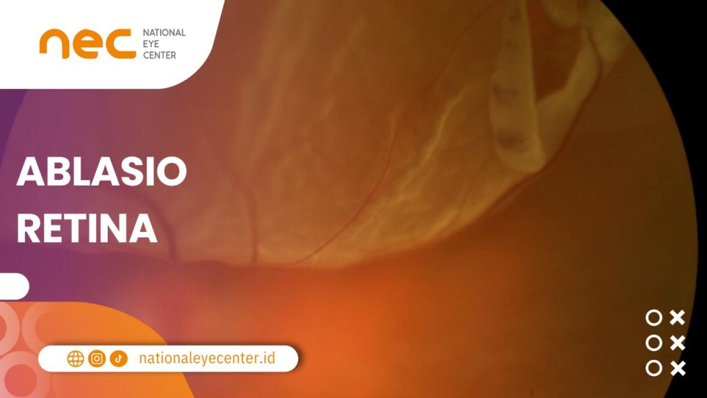 Salah satu kondisi yang memengaruh kilatan cahaya di samping mata, yakni ablasior retina .