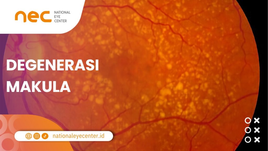Salah satu kondisi yang memengaruh kilatan cahaya di samping mata, yakni AMD.