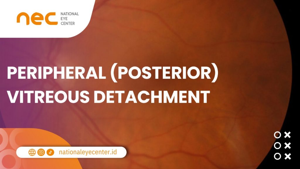 Salah satu kondisi yang memengaruh kilatan cahaya di samping mata, yakni PVD.