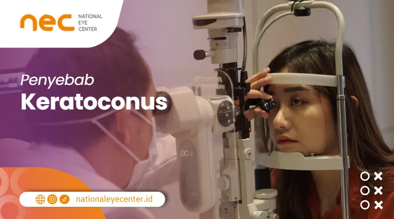 Penyebab Keratoconus