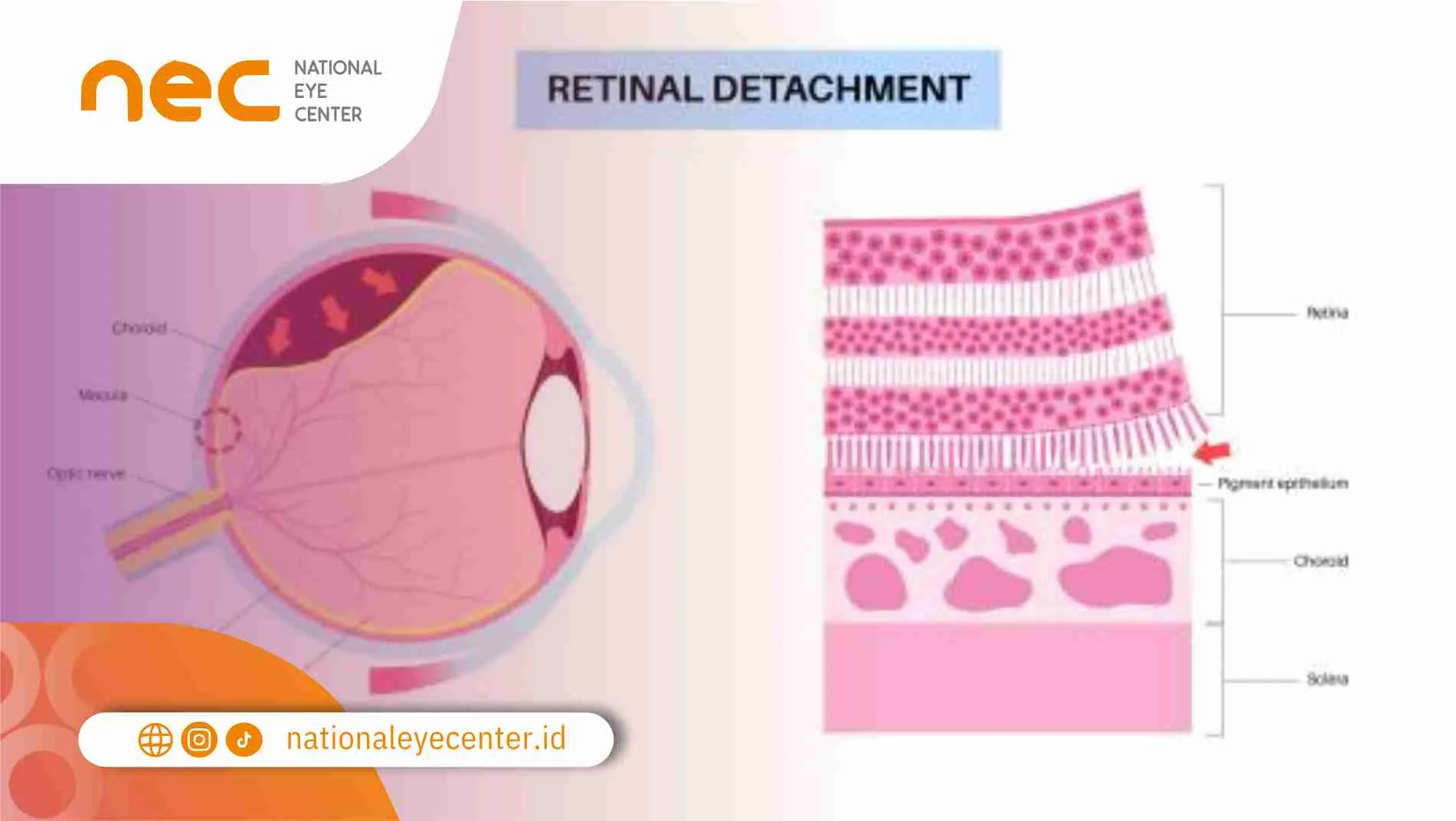 Penyakit yang Dapat Timbul di Vitreoretina