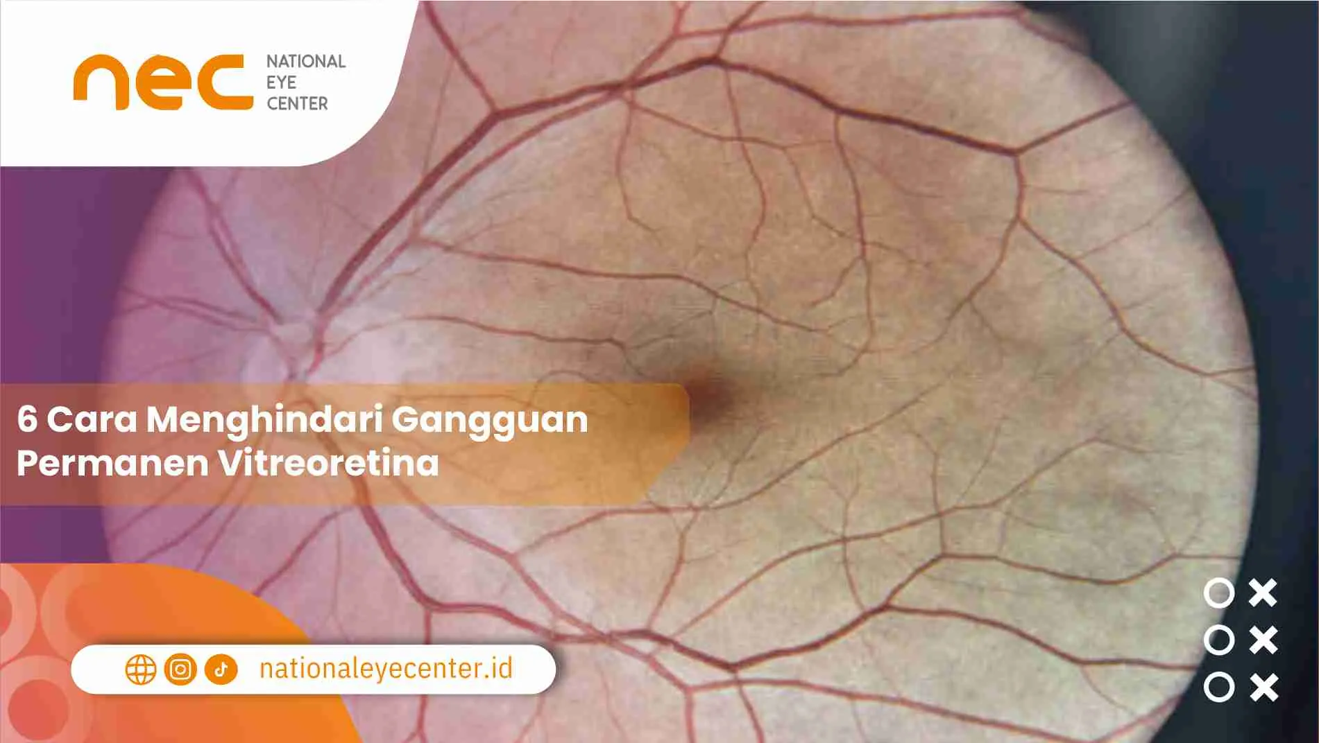 6 Cara Menghindari Gangguan Permanen Vitreoretina