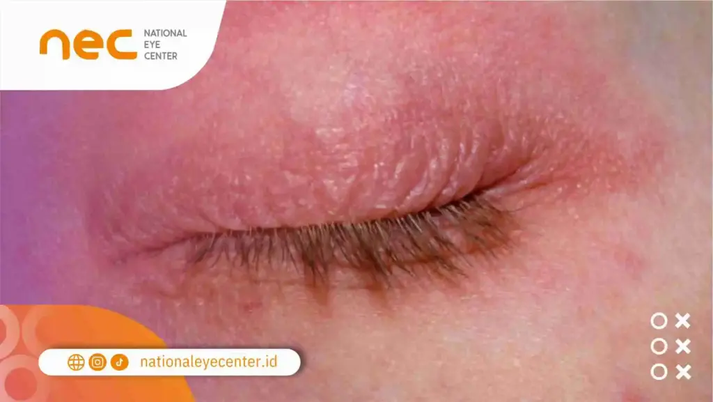 Apa Itu Eksim Kelopak Mata (Eyelid Dermatitis)?