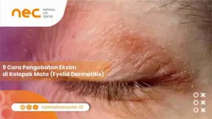 9 Cara Pengobatan Eksim di Kelopak Mata (Eyelid Dermatitis)