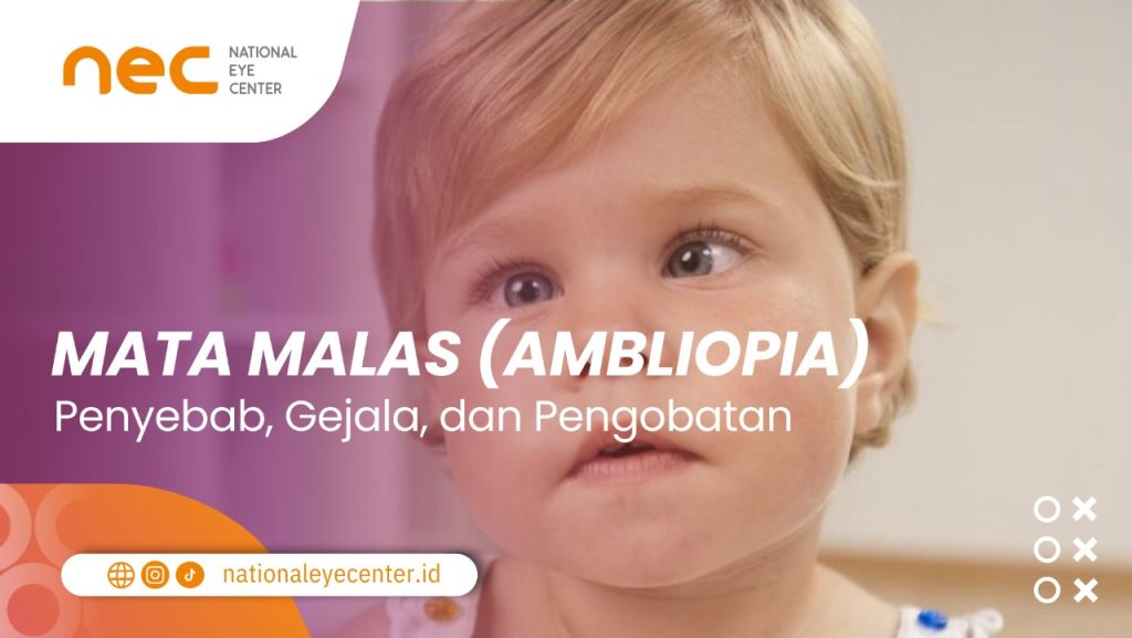 Gambar utama untuk artikel berjudul "Mata Malas (Ambliopia) – Penyebab, Gejala, dan Pengobatan".