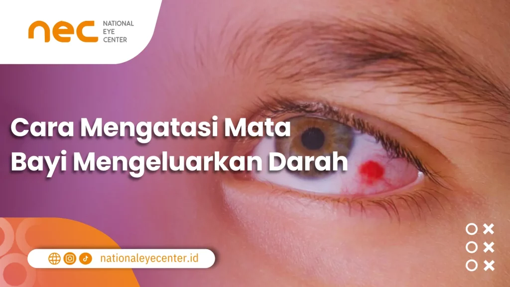 Mata Bayi Mengeluarkan Darah: Gambar menunjukkan adanya titik merah pada mata.