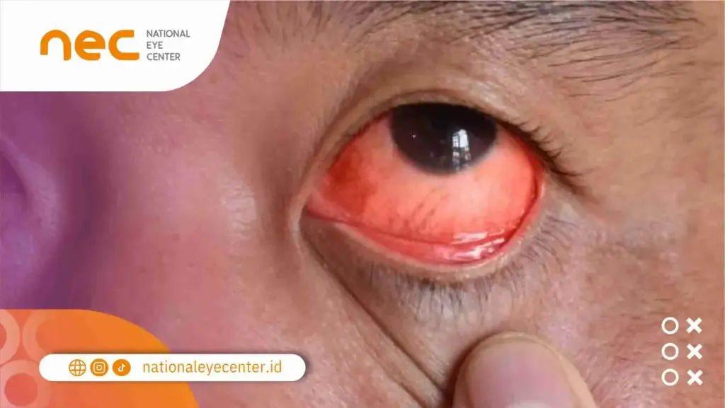 Penyebab Luka pada Kornea Mata