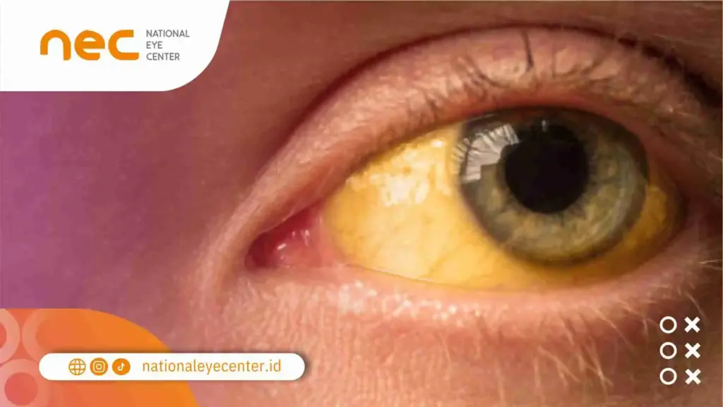Mata Kuning Tak Kunjung Sembuh? Periksa di NEC Aja!