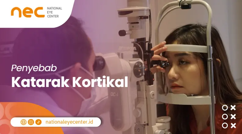 Penyebab katarak kortikal
