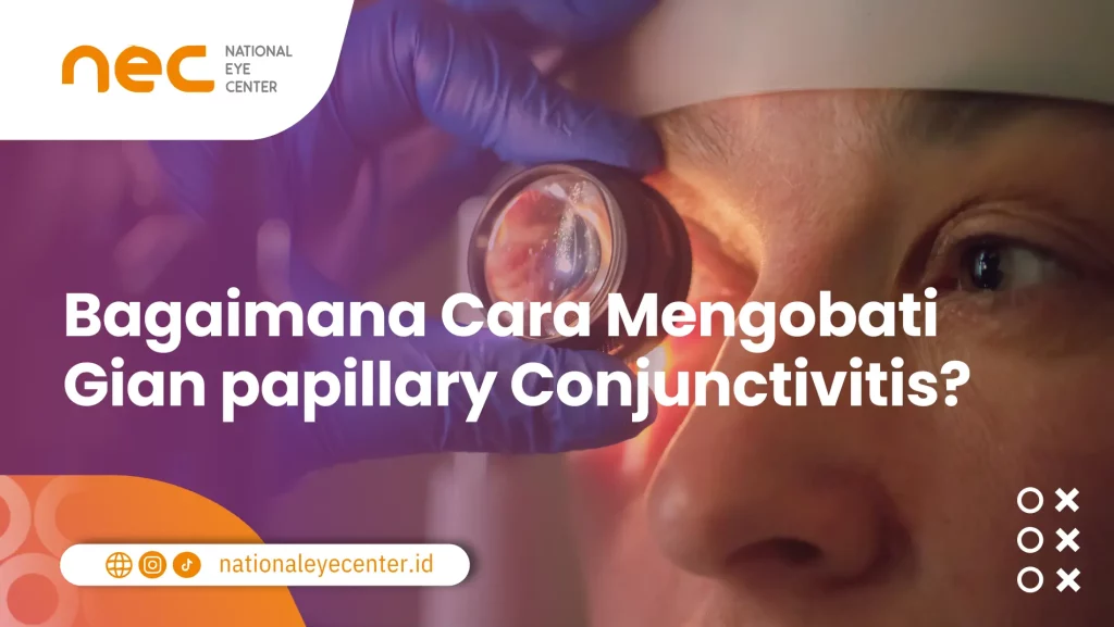 cara mengobati giant papillary conjunctivitis