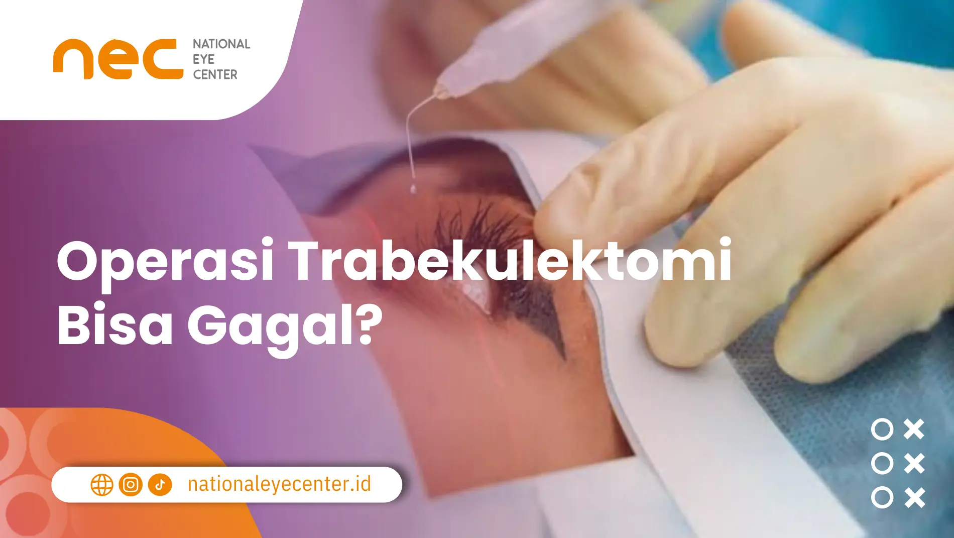 Apa Itu Trabekulektomi pada Mata? Simak Penjelasannya Berikut Trabekulektomi