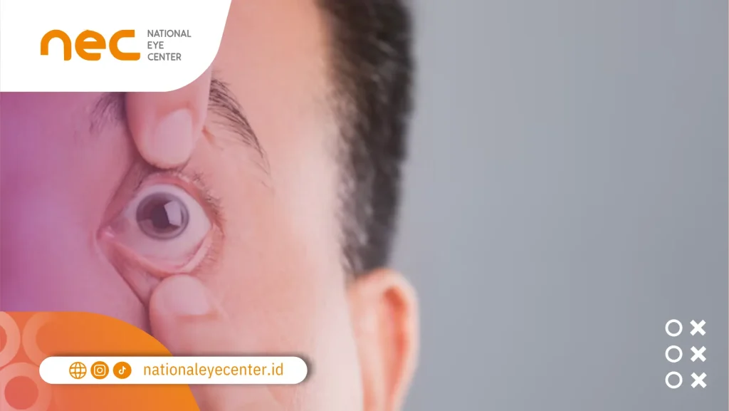 Penyebab dari Anisocoria