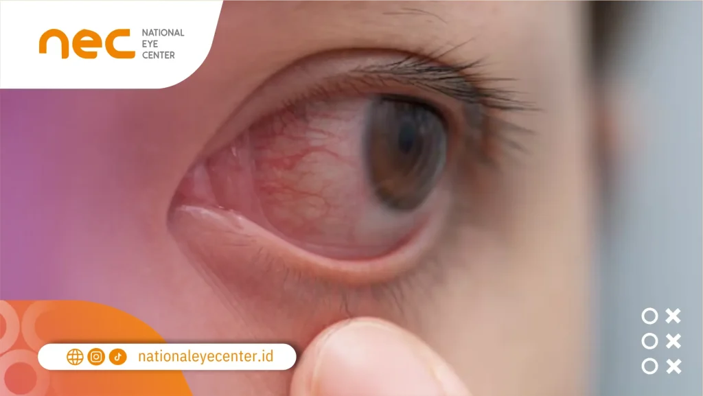 Apakah Anisocoria dapat diturunkan?