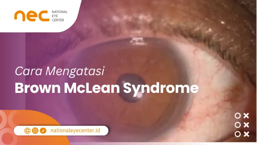 Brown McLean Syndrome
