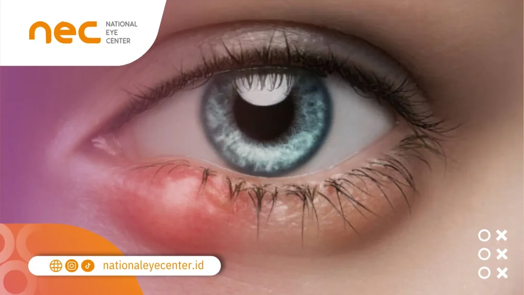 Mengapa Bintitan Sering Kambuh?